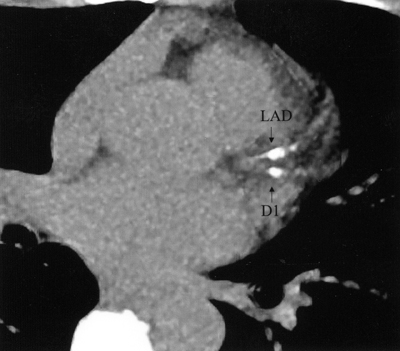 electron beam tomography